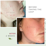 Glow Getter Blemish-Free Hydration Serum | All-in-One Serum + Moisturizer